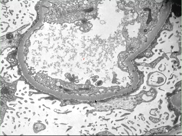 LilianCVillalba's tweet image. #MET #LCM Se observa fusión pedicelar. Además, se nota acúmulos oscuros hacia las membranas basales, son filamentos de actina por desestructura del citoesqueleto. Las rayitas alrededor son pedicelos degenerados denominados "degeneración microvellosa". Dra Segura 🇨🇱