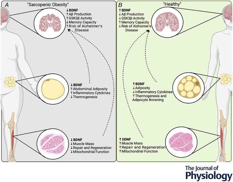 JPhysiol's tweet image. Emily N. Copeland (@BrockFAHS) and co-authors examine the possibility that reduced levels of brain-derived neurotrophic factor may serve as the underlying commonality between sarcopenic #obesity and #Alzheimer's disease 🔎 🔬 

🔗Read the #TopicalReview: buff.ly/Zj4NuVW