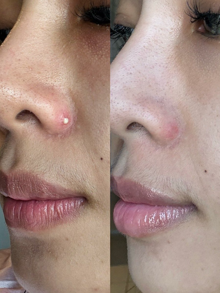 ตัวนี้โคตรดีอะ  Eucerin Gel To Foam
ตั้งแต่เปลี่ยนมาใช้อันนี้ สิวอักเสบที่เคยปวดๆ ยุบไวมากกก ล้างแล้วหน้าสะอาดไม่เอี๊ยดด ผิวก็มันน้อยลงด้วย ใครเป็นสิว ผิวมัน ลองใช้ดูนะ เวิร์คจริง 👍