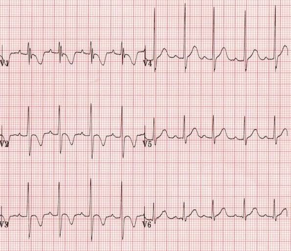 ECG shows tall, peaked T-waves and a widened QRS complex. 📉⚡ Likely ...