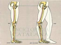 sasutra3's tweet image. Características de la #Hiperextensión de la #Rodilla de un #Futbolista
#Fisioterapia #Fisioterapeutas #FisioterapiaDeporrtiva #Fisio #Balón
acortar.link/5z5gSC