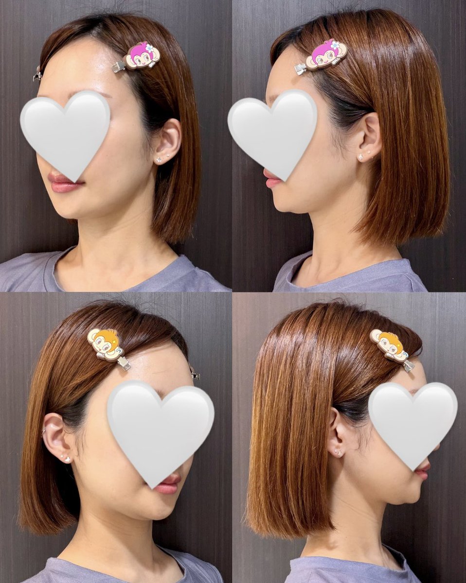 輪郭2点レポ✍🏻
DT 5ヶ月
（インディバ10回以上済み）

・開口は指二本分
・顎下のたるみもまだある

#マックス口腔顎顔面外科
#輪郭2点　（エラ・顎）
#マックス口腔外科
<a href="/MACSJPPS/">MACS口腔顎顔面外科«両顎・輪郭専門»</a>