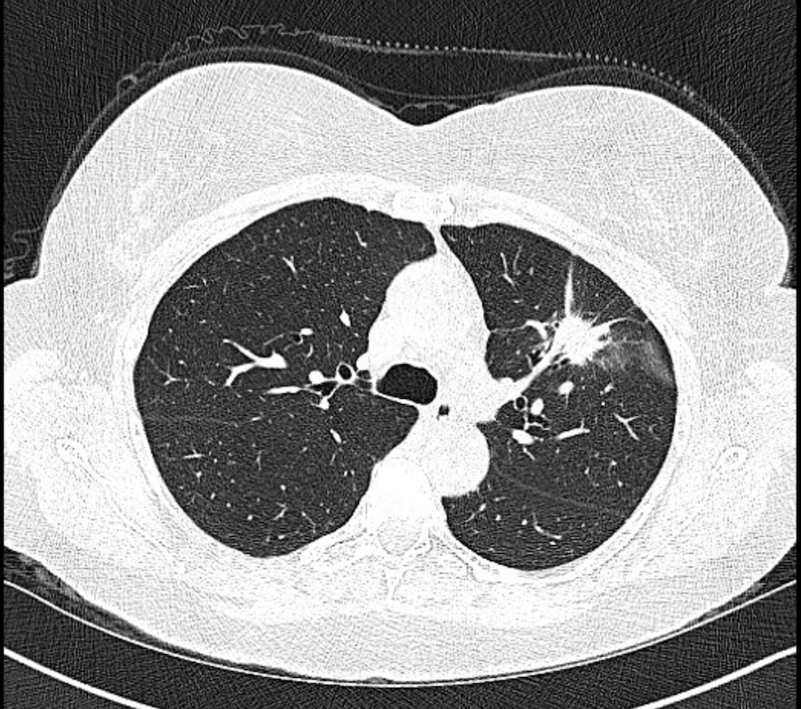 GS_Bronch tweet media