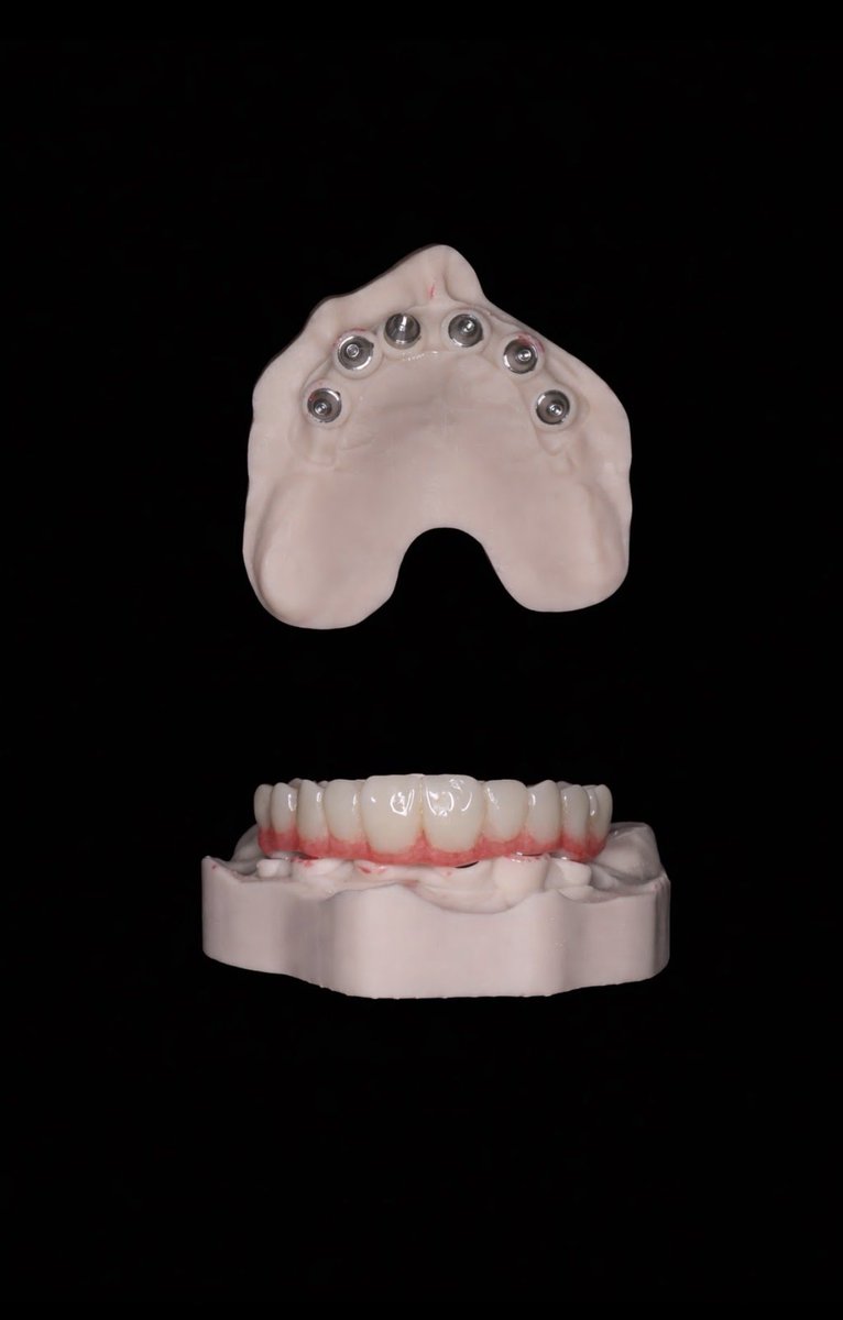 aom090's tweet image. حالة تعويض كامل للفك باستخدام زراعة الأسنان مع تركيبة ثابتة (Hybrid prosthesis)، أعادت للمريض الوظيفة والشكل الطبيعي في نفس الوقت.

🔹 ثبات عالي
🔹 شكل طبيعي
🔹 استعادة كاملة للمضغ والابتسامة

التفاصيل تصنع الفرق دائمًا 👌

#زراعة_الأسنان #تعويض_كامل #Prosthodontics #Digital