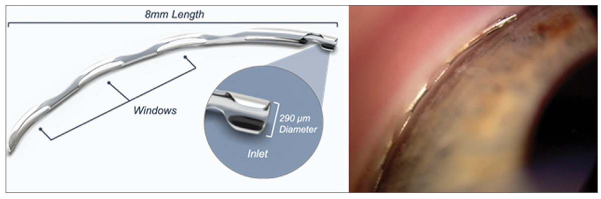 revoptom's tweet image. Getting in the Glaucoma Groove

Here are important factors to keep in mind when evaluating patients and assessing the tradeoffs of potential surgeries: reviewofoptometry.com/article/gettin…

#optometry #eyecare #optometrist #eyedoctor #glaucoma #glaucomacare