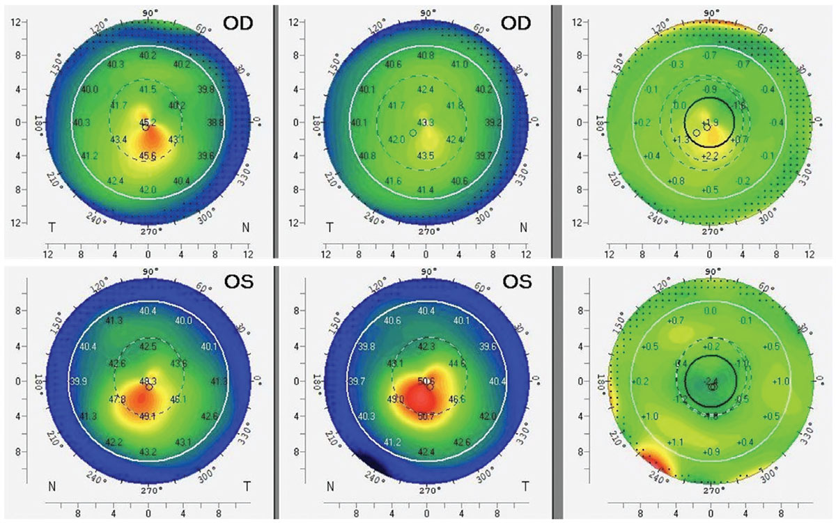 revoptom's tweet image. My Patient Has Keratoconus… Now What?

Effectively communicating a three-pronged approach and definitive next steps to dealing with this disease can help ease patients’ concerns.
reviewofoptometry.com/article/my-pat…

#keratoconus #optometry #eyecare #cornea