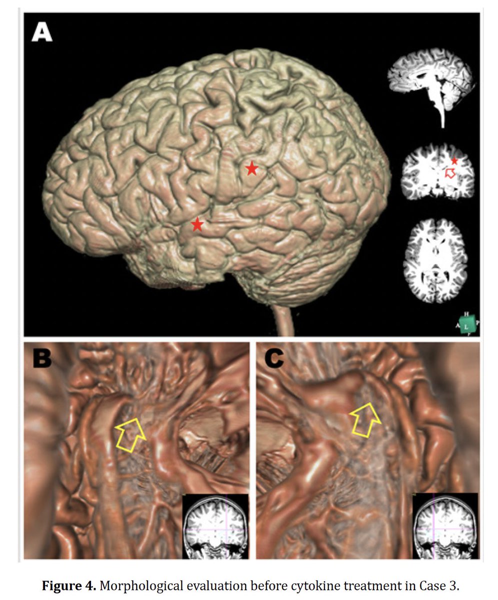 mathewsopenaccess.com/journals/case-…

Cytokine-induced Neurogenesis for the Treatment of IVF-induced ASD
Takuji Shirasawa1,2*, Luis Carlos Aguilar Cobos3
1Ochanomizu Health and Longevity Clinic, Tokyo 101-0062, Japan
2Shirasawa Anti-Aging Medical Institute, Tokyo 101-0062, Japan
3Livant