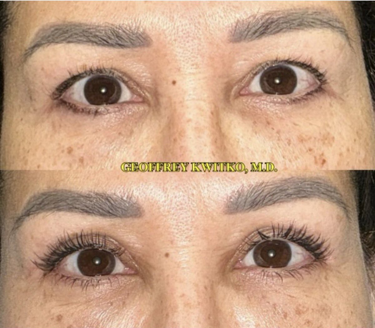 Perfect natural blepharoplasty by one of the world’s most experienced eyelid surgeons .
📲813-877-8665