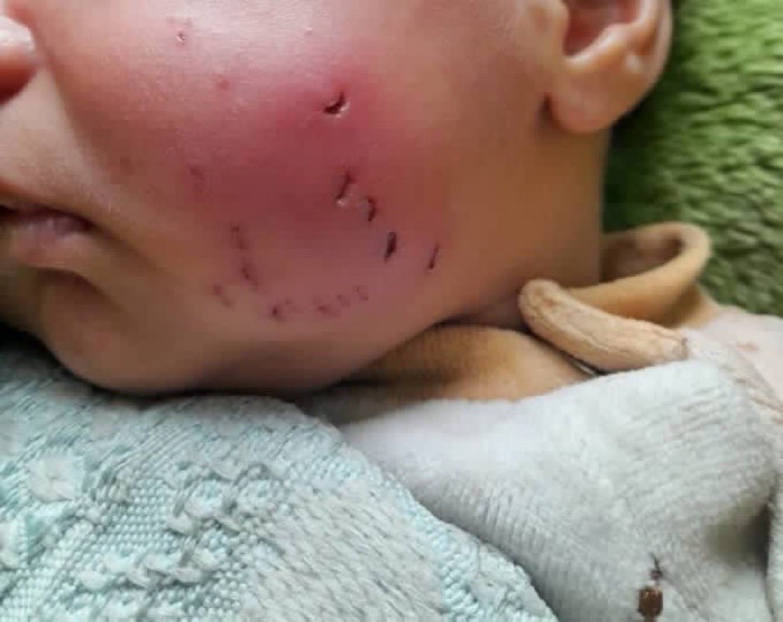 Ferhat10630's tweet photo. Gazze'deki çadırlarda yaşam koşulları çok ağır.

Bu küçük çocuğu çadırında uyurken bir fare ısırdı. Çocuk şu anda Gazze'deki bir hastanenin yoğun bakım ünitesinde tedavi görüyor. https://t.co/pVQIL9Wwb9