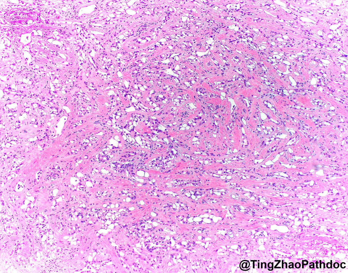 TingZhaoPathdoc's tweet photo. 🔬Location? Diagnosis?
#PathTwitter
@MGHPathology @MGBpathology https://t.co/VEFMlYgNh5