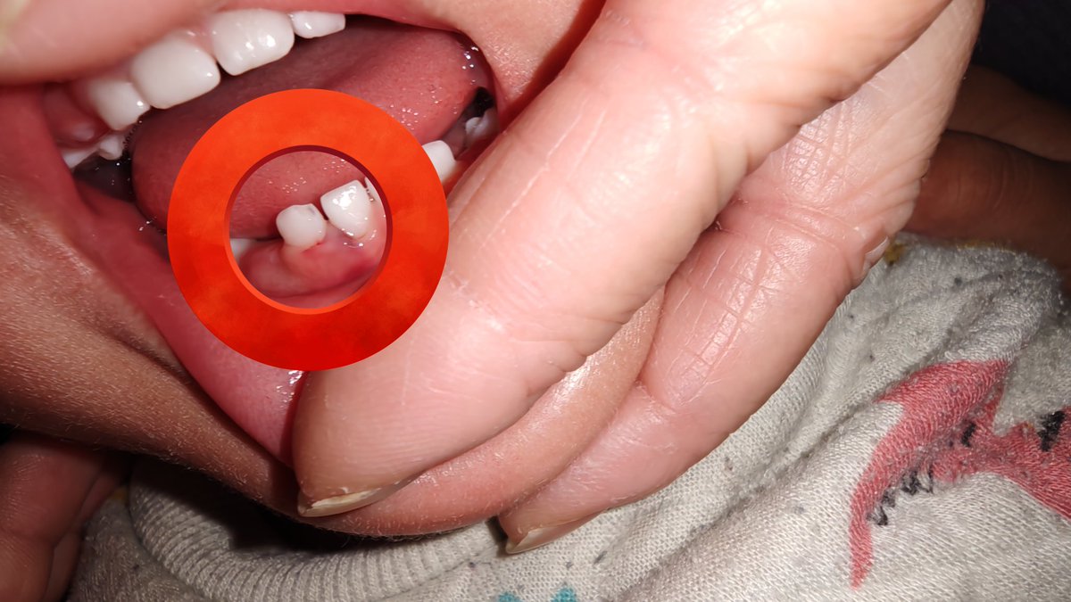 おはようございます❗️
木曜日無事に1歳半健診も終わってホッとしていた矢先、夜にテーブルで口を打って出血&amp;右下のBが欠けました😫
金曜日歯医者へ行くために🍛お休み😢
とりあえず様子見で大丈夫とのことでしたが歯肉も腫れてるし可哀想😭
これから染みなかったらええけど💦
子供ってほんま大変🥹