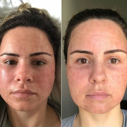 veehrdadeiro's tweet photo. assim fica o rosto da ana com perfume sem antialérgico e eles não estão fazendo nada ela tá toda vermelha ja eu to apavorado eles vão acabar fazendo ela desistir por saúde se não for essa a intenção https://t.co/WvyLHMXmfV