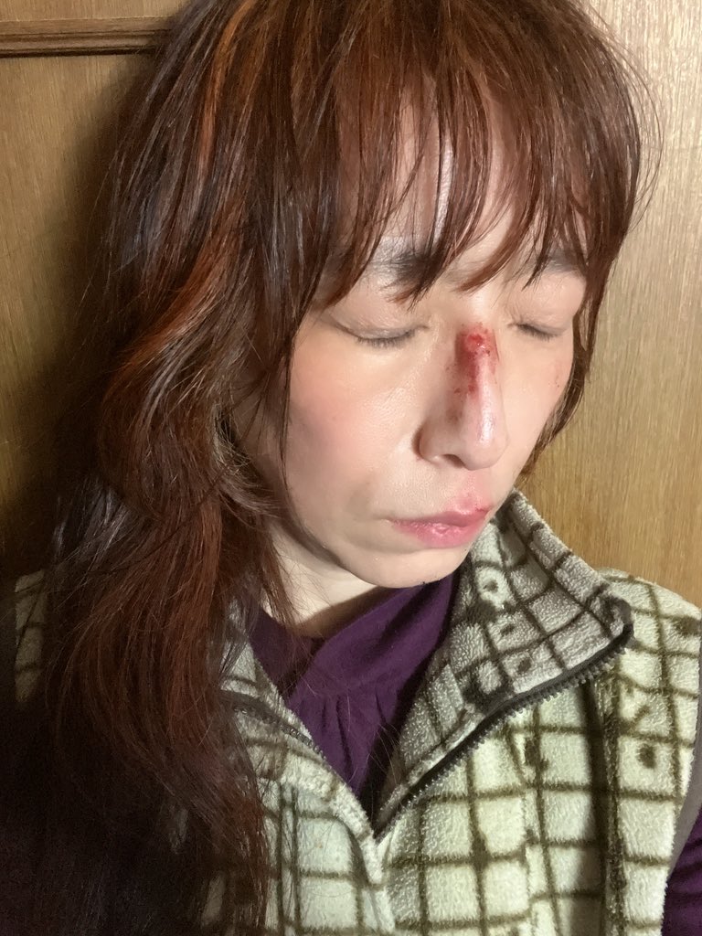 si_o_n's tweet photo. 2026/03/28
昨日、酔っ払っていて、顔からこけたのよw
家に帰って、写真撮ったら、ありゃりゃー。
酔っ払ったら、走ってはいけませんよww酔っ払い運転ですから、ソレww https://t.co/mpG210SS4P