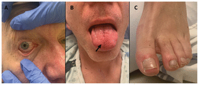 guerreroespejo's tweet image. 60-YO♂️, 4 weeks earlier PCR + for SARS-CoV-2 infection (not Covid vaccination): shortness of breath, fever, lymph node⬆️of his neck, conjunctivitis (A), erythema &amp;amp; ⬆️of his tongue (B), pitting edema, &amp;amp; erythema of his toes (C).
1/3
#medicine #microbiology
doi.org/10.1503/cmaj.2…