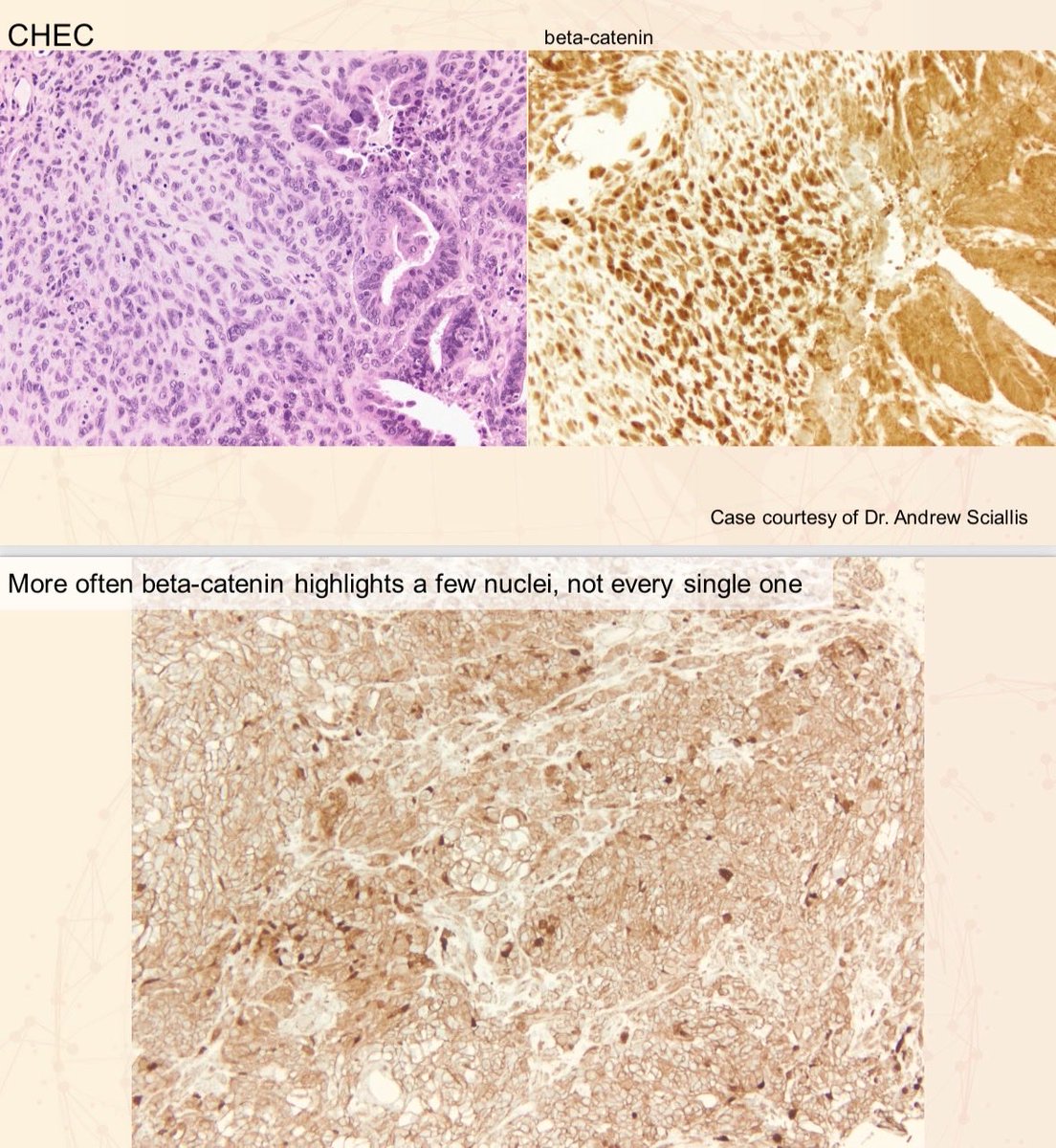 Corded &amp; Hyalinized Endometrioid Carcinoma (CHEC)
• Usually associated with low-grade endometrioid carcinoma
• CHEC component shows nuclear β-catenin staining
• Most commonly misdiagnosed as carcinosarcoma

β-catenin IHC tip:
Ideal pattern (strong/diffuse nuclear, pic 2)