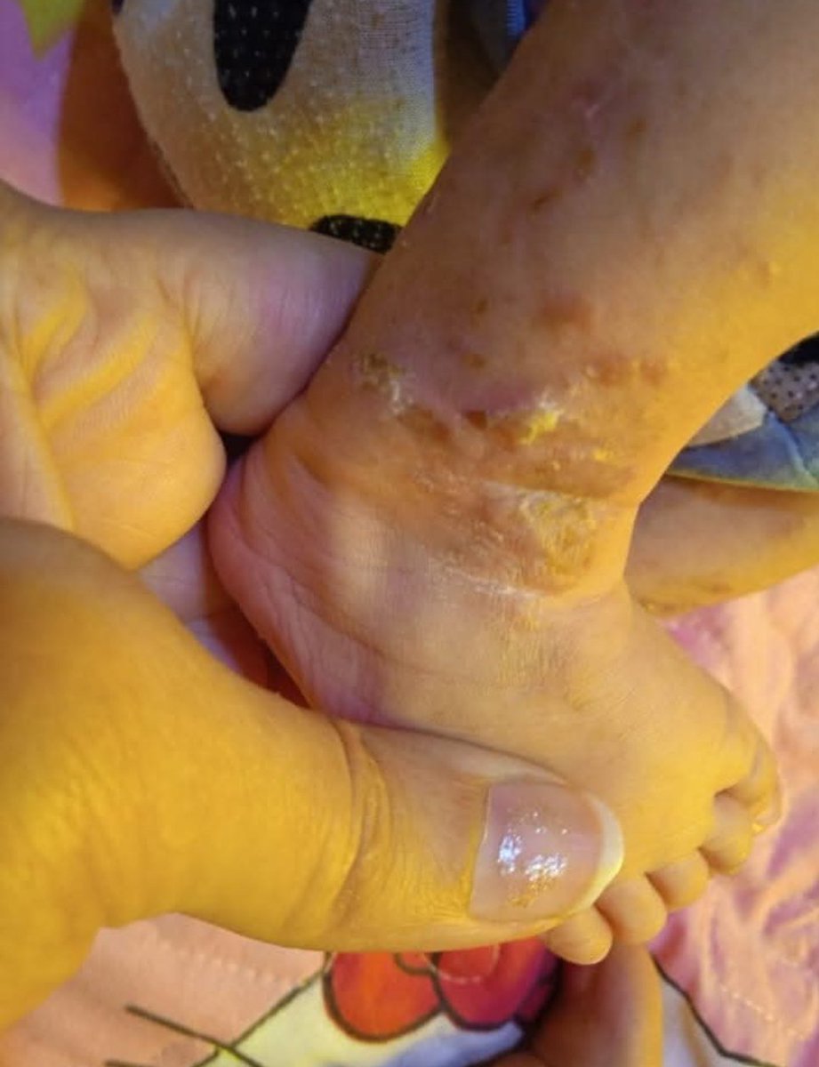 My child has severe infections and blisters on his foot. He is suffering incredibly and urgently needs your help. 

chuffed.org/project/154635…