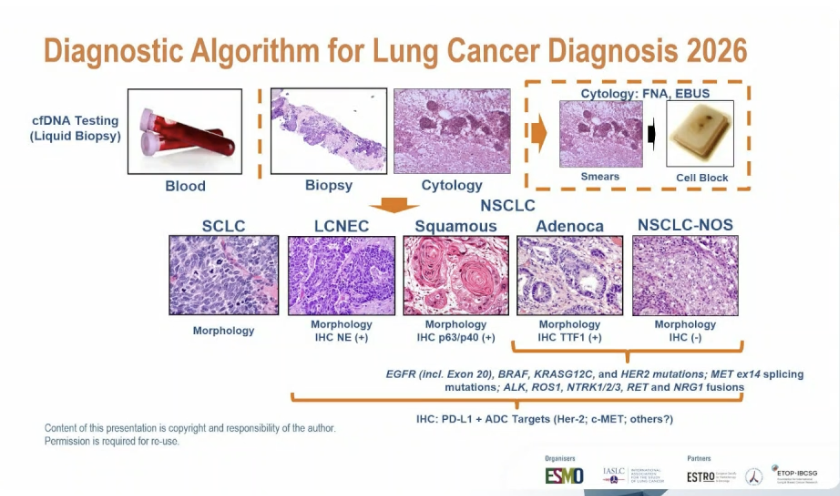 bmassutis's tweet photo. Lung cancer diagnosis and molecular pathology @MdWistuba at #ELCC2026 @OncoAlert https://t.co/Pk1EhCX7Hn