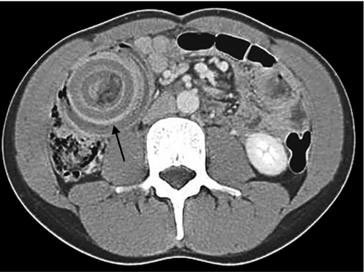 hemo_shk's tweet image. What is the radiological sign?

What is the diagnosis?

Clue Red Currant Jelly stools.

#MedTwitter #MedEd #MedX #Medicine #MEDHM