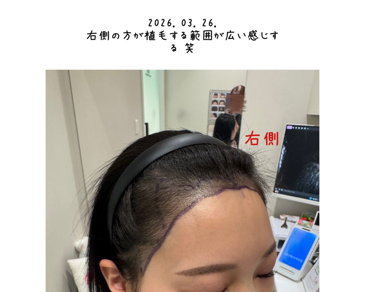 0c__73's tweet photo. ずっと気になってたM字、韓国で植毛してきたよ💉 ゛ https://t.co/9uJ6At7Tqn