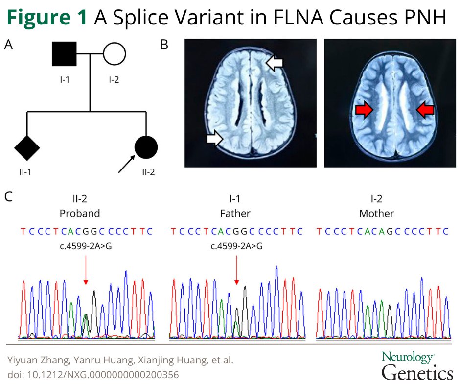 GreenJournal's tweet image. This study broadens the phenotypic and genetic spectrum of PNH, demonstrating a dual PNH phenotype associated with a bi‑transcript mechanism and mosaic inheritance, including tissue‑specific mosaicism: hubs.la/Q048j4Rj0 

#NeuroTwitter #NeuroX