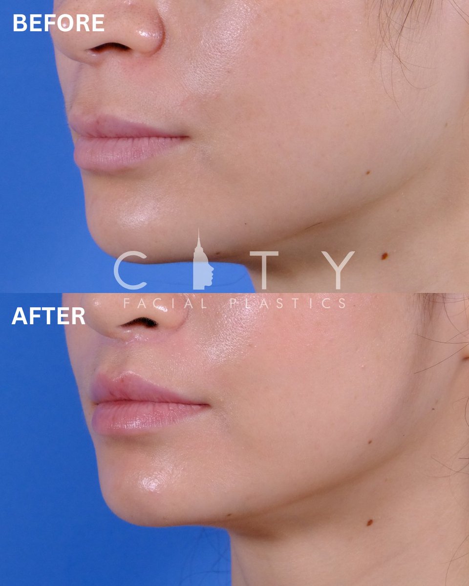 drgarynyc's tweet image. 3 months post elelyft lip lift.  A shorter philtrum, enhanced upper lip fullness and the perfect touch of tooth show. 

For consultations please give our office a call at 347-427-9141

#lipliftnyc #plasticsurgery #beforeandafter #lips #elelyft