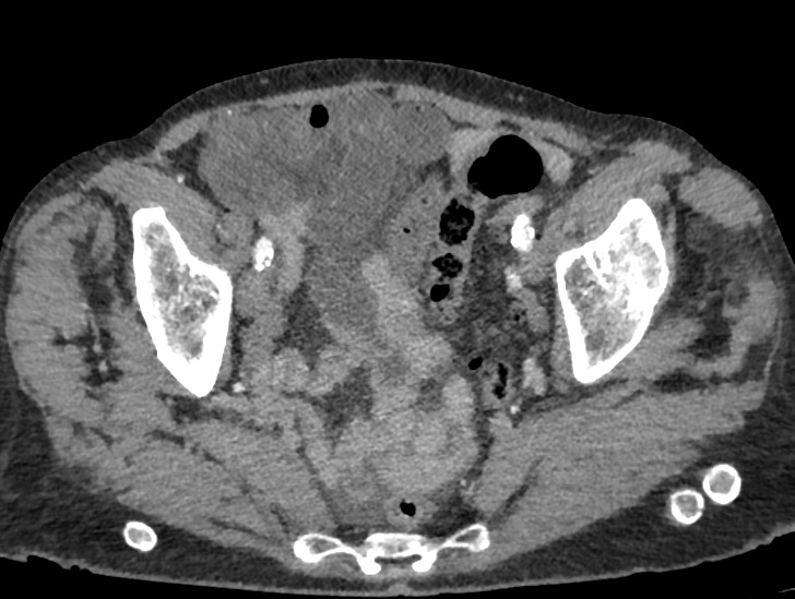 draceciferrario's tweet image. Critical finding ⚠️
This could change surgical management... 
Do you know what we’re looking at?

#radiology #medicine