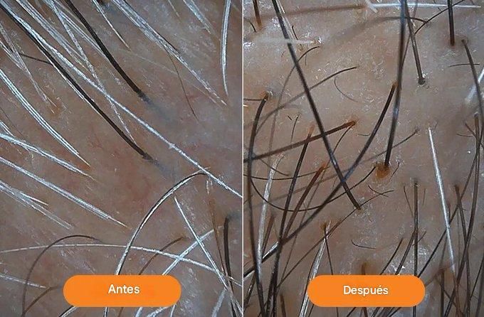 YosuepEstebanX's tweet photo. Las canas no son sinónimo de envejecimiento.

Son una señal de alerta.

Una de cada cuatro personas tiene canas antes de los 30.

Y la industria de la belleza sabe por qué... pero no te lo dirá.

Aquí está la verdad (y cómo revertirlas de forma natural): 🧵 https://t.co/1IbgTc0ZQL