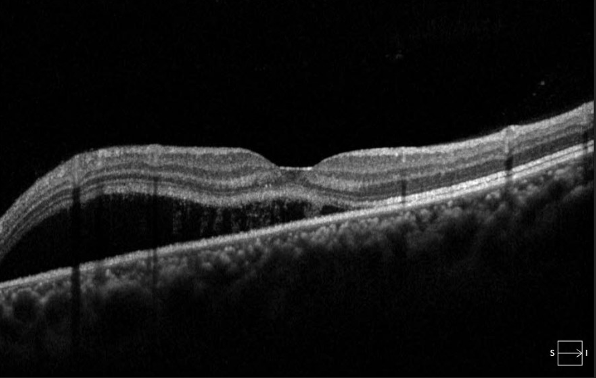 TheRetinaSociety tweet media