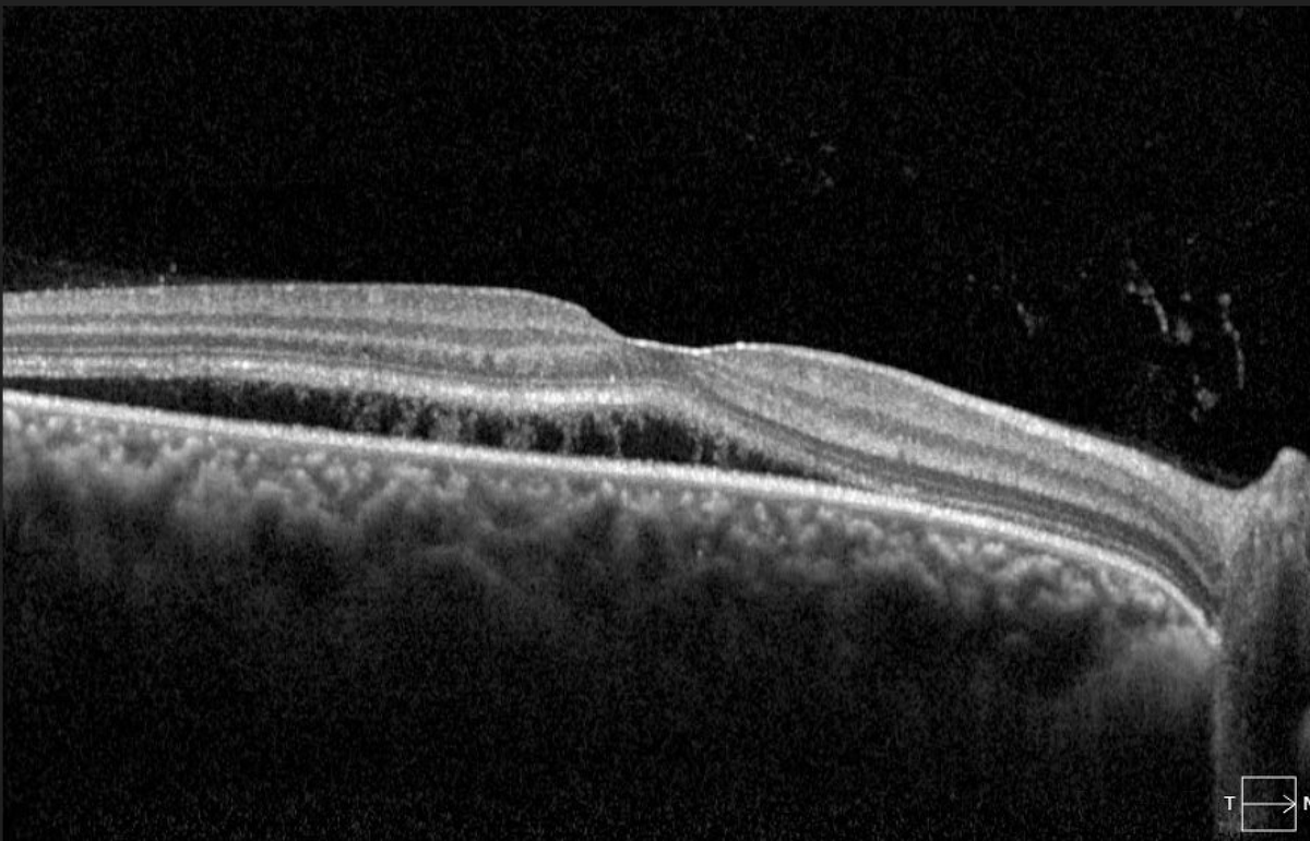 TheRetinaSociety tweet media