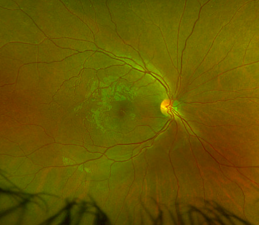 TheRetinaSociety tweet media