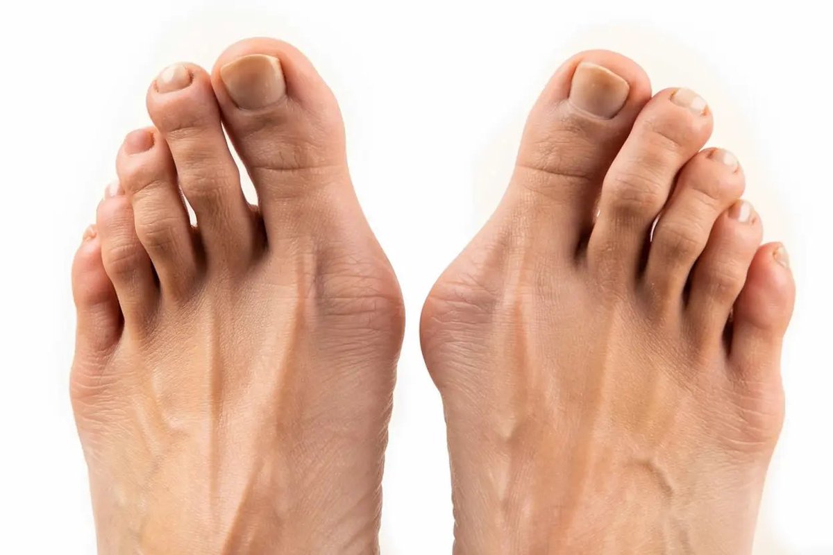 في تشوه ( انحراف اصبع إبهام القدم )
Hallux valgus

اختيار نوع العملية يجب أن يعتمد على شدة التشوه ومكان الانحراف و ليس على تفضيل الجراح لتقنية معينة لذا 
العملية المناسبة للحالة هي مفتاح النجاح