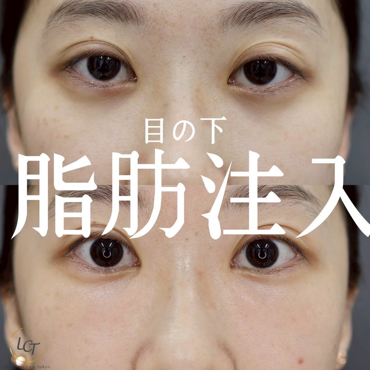 本日1件目は他院修正による目元の脂肪注入です！

他院脱脂後に悩まれている方が、多くご来院されております。
【短時間で気軽にくま取りができる】と思われがちですが、手術には必ずリスクがあります！クリニック選び、医師選びはとても大切です‼︎

lumiere---clinic.com