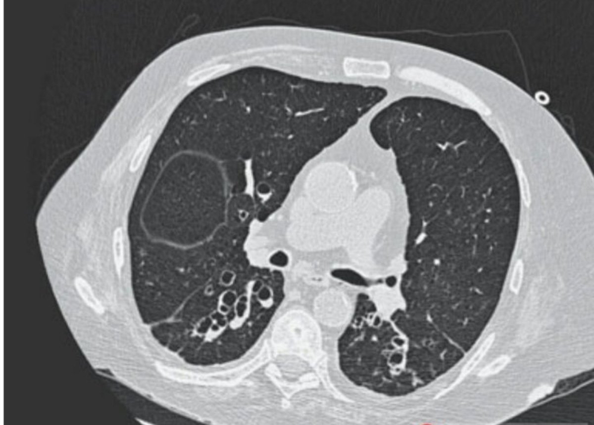 SameerYogi14's tweet image. CT chest shows dilated bronchi with cystic “cluster of grapes” appearance- what is the diagnosis?
#Medx
@docakx @Dr_Shiv_kumar_ @daoo100 @IhabFathiSulima