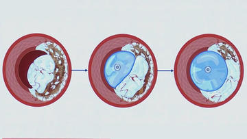 PCRonline's tweet photo. Plaque modification in different lesions types: nodular, long lesions, tortuous lesions, bifurcations

📺https://t.co/L3cw2x8UJY

Watch the replay of this #Euro4C 2026 session: 
Explore advanced plaque modification strategies tailored to diverse  lesion types such as nodular, long, tortuous lesions, and bifurcations. Find out more about managing under-expanded stents and calcified  nodules, supported by evidence including results from the French orbital  atherectomy registry.

@MilasinD18 @nicolasamabile @JacquesMonsegu 

#interventionalcardiology