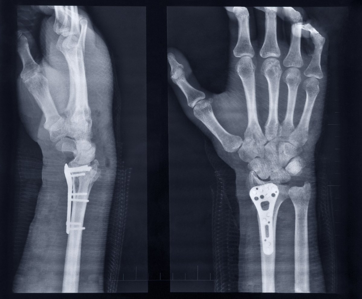 SHIVAM4362's tweet photo. Chinese researchers have developed "Bone-02," a biodegradable, bio-adhesive that repairs fractures within 3 minutes https://t.co/61JsSMsQz0