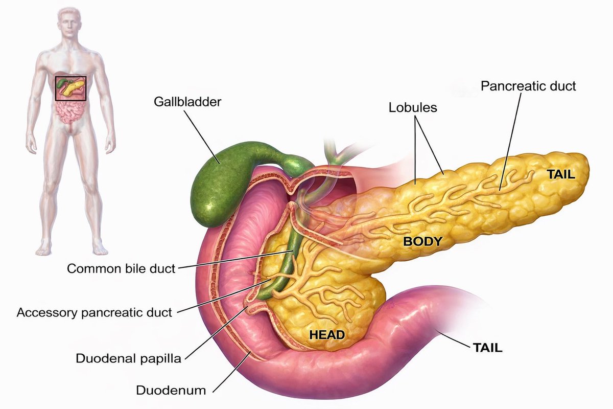 YasserRtt's tweet photo. 🧵 (1/10)
دراسة حديثة من BMC Pulmonary Medicine (2026) قارنت بين NIV vs HFNC في مرضى acute pancreatitis المصابين بفشل تنفسي.  

هل أبدأ بـ HFNC لأنه مريح وسهل؟
أو أروح مباشرة لـ NIV لأنه يعطي دعم تنفسي فعلي؟
الدراسة حاولت تحسم هذا الجدل باستخدام بيانات كبيرة جدًا (>7000 مريض). https://t.co/Z332vFaBfO