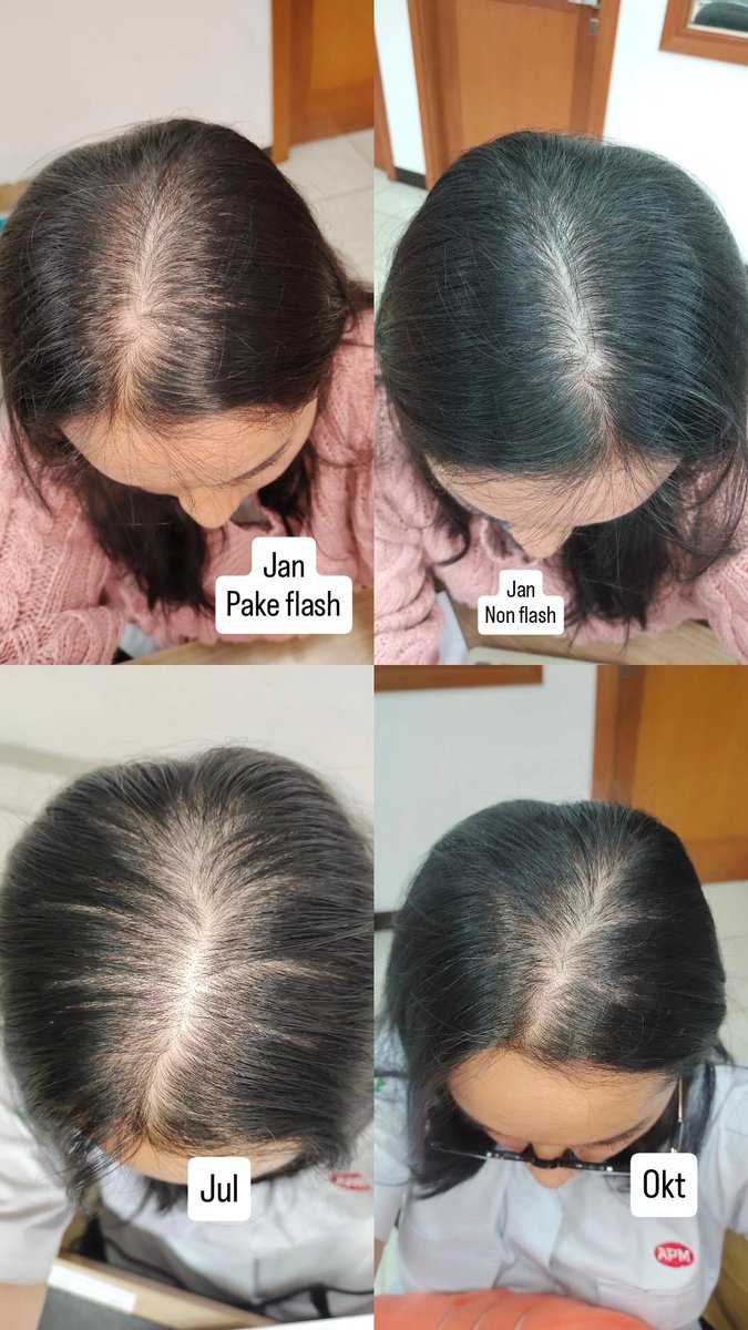 Ryulismm's tweet photo. @tanyarlfes Nder percaya deh mendingan lgsg pake regrou minoxidil yg 2% nih hasilnya https://t.co/5ALoA1BEW2