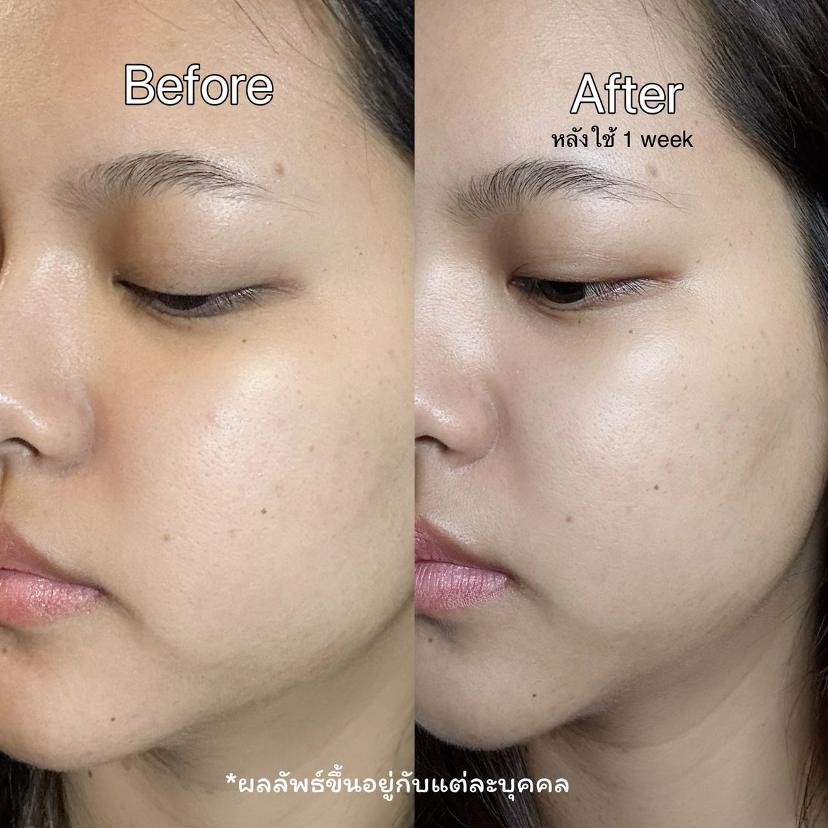 ขอมาป้ายยาเซรั่มที่ใช้ช่วงนี้แล้วชอบมาก
Eucerin Booster Serum ลองใช้แล้วรู้สึกว่า ผิวดูใสขึ้น พวกฝ้าแดด รอยดำดูจางลงไวขึ้น แล้วเป็นเซรั่มที่คนรีวิวเยอะมาก เพราะมีไทอามิดอล สารไบรท์เทนนิ่งที่แพทย์บอกว่าดีที่สุดแล้วตอนนี้ ชอบที่เนื้อบาง ซึมเร็ว ไม่เหนอะ หลังใช้หน้าดูไบรท์ขึ้นจริง