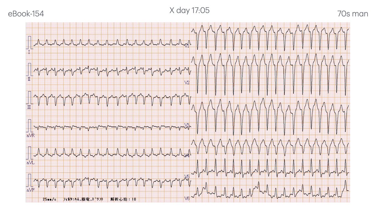 N. Tsukishima EP大学心電図検定学部試験対策科担任 tweet media