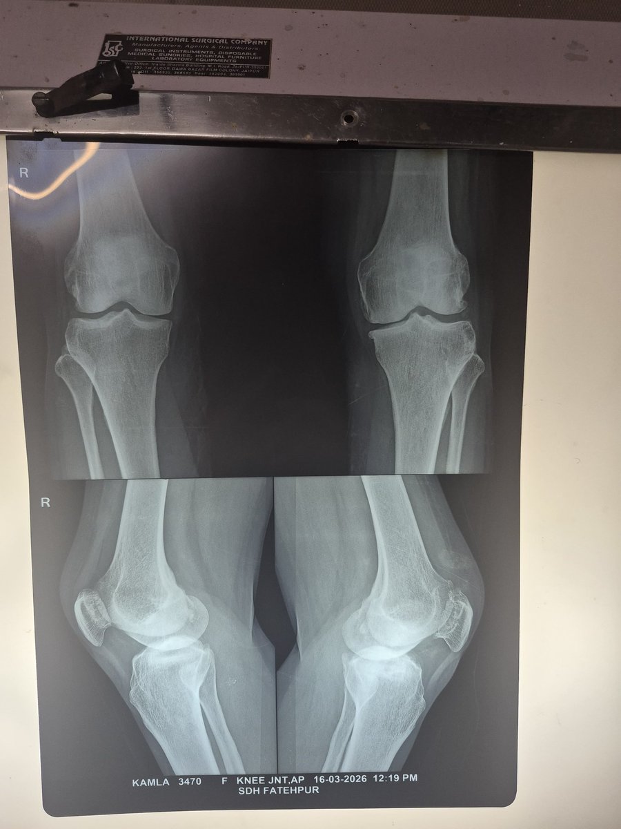 suburb_monk's tweet image. “From standing beside the OT table to leading the procedure—today marks my first successful Total Knee Replacement at SMS Hospital, Jaipur.
Mentorship by Dr. Anurag Dhaker sir made this possible.
Long way to go, but a strong first step taken.
#Journey #TKR #Orthopedics #Growth