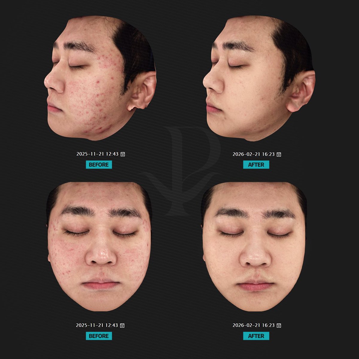 Project U clinic《プロジェクトユー》韓国美容皮膚科 tweet media