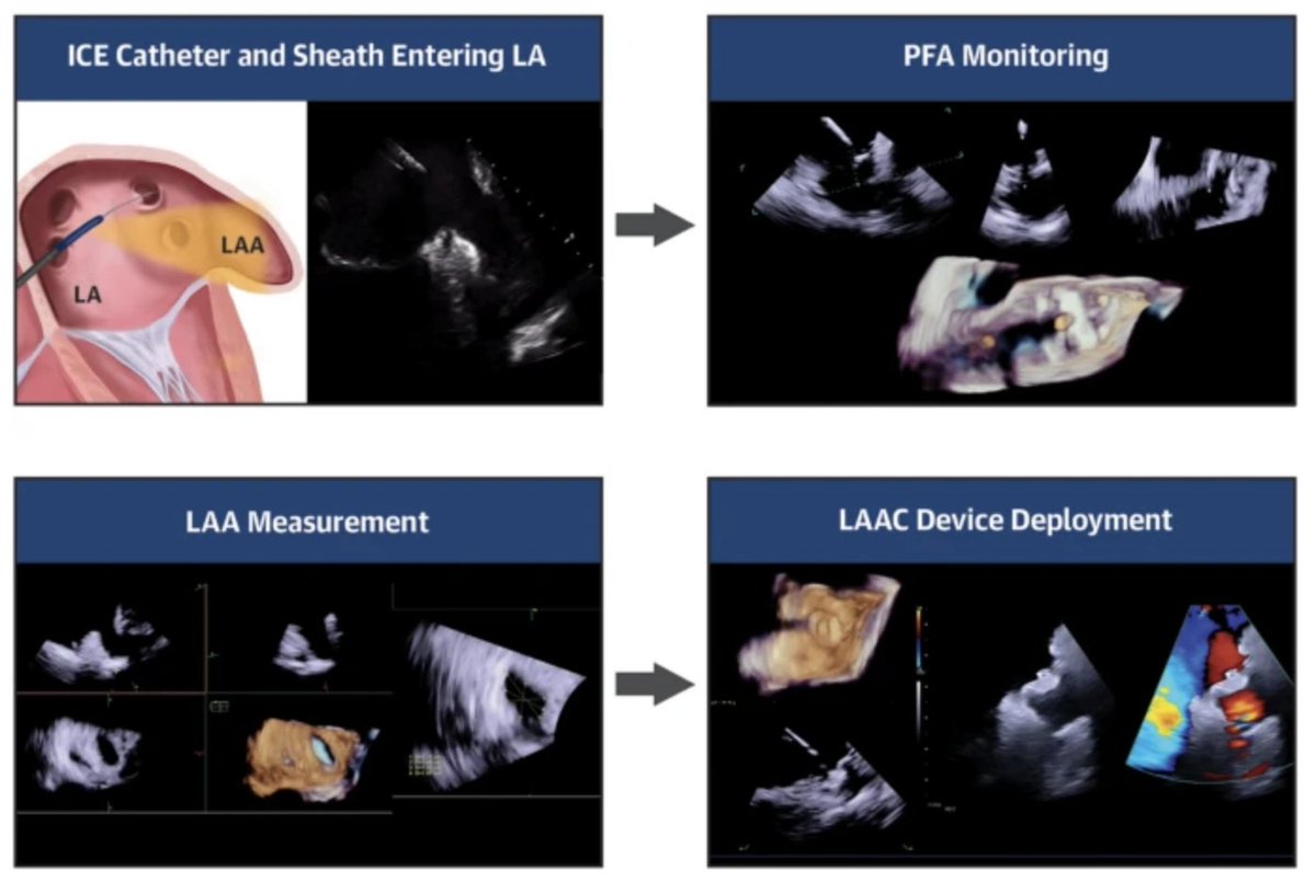 JICE_EP's tweet image. 🚨Latest #FreeRead Article in
@JICE_EP

The Role of 4D ICE Imaging for Concomitant PFA and LAAC: a Procedural Workflow

🧐📖rdcu.be/faEPu

by @Drdevignair, Yingnan Song &amp;amp; Myra Cocker

#EPeeps