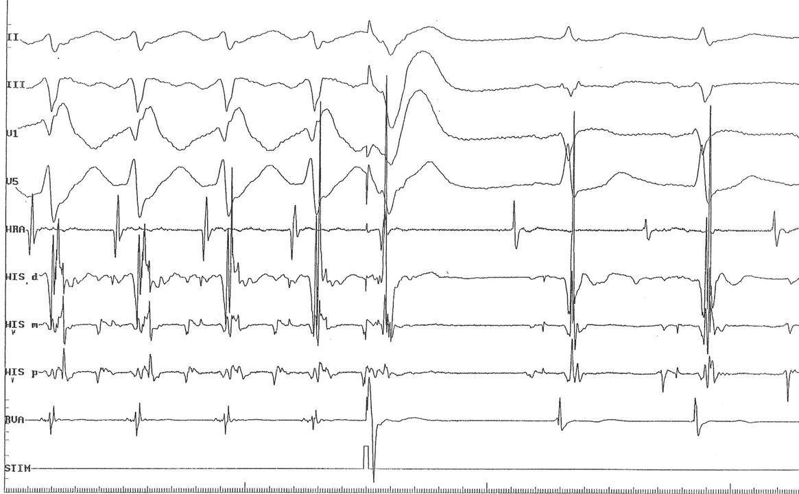 ChartAcademy's tweet image. #SundaySchool
🔗 Link in bio
V stim during tach: 🤓

A. Concealed AP is present, but ORT can't be confirmed
B. Concealed AP is present, and this is ORT
C. Tachycardia is atypical AVNRT

#CEPS #RCES #EPeeps #VivaEP #EGMReview

Curious for more like this?
bit.ly/3MAYKy