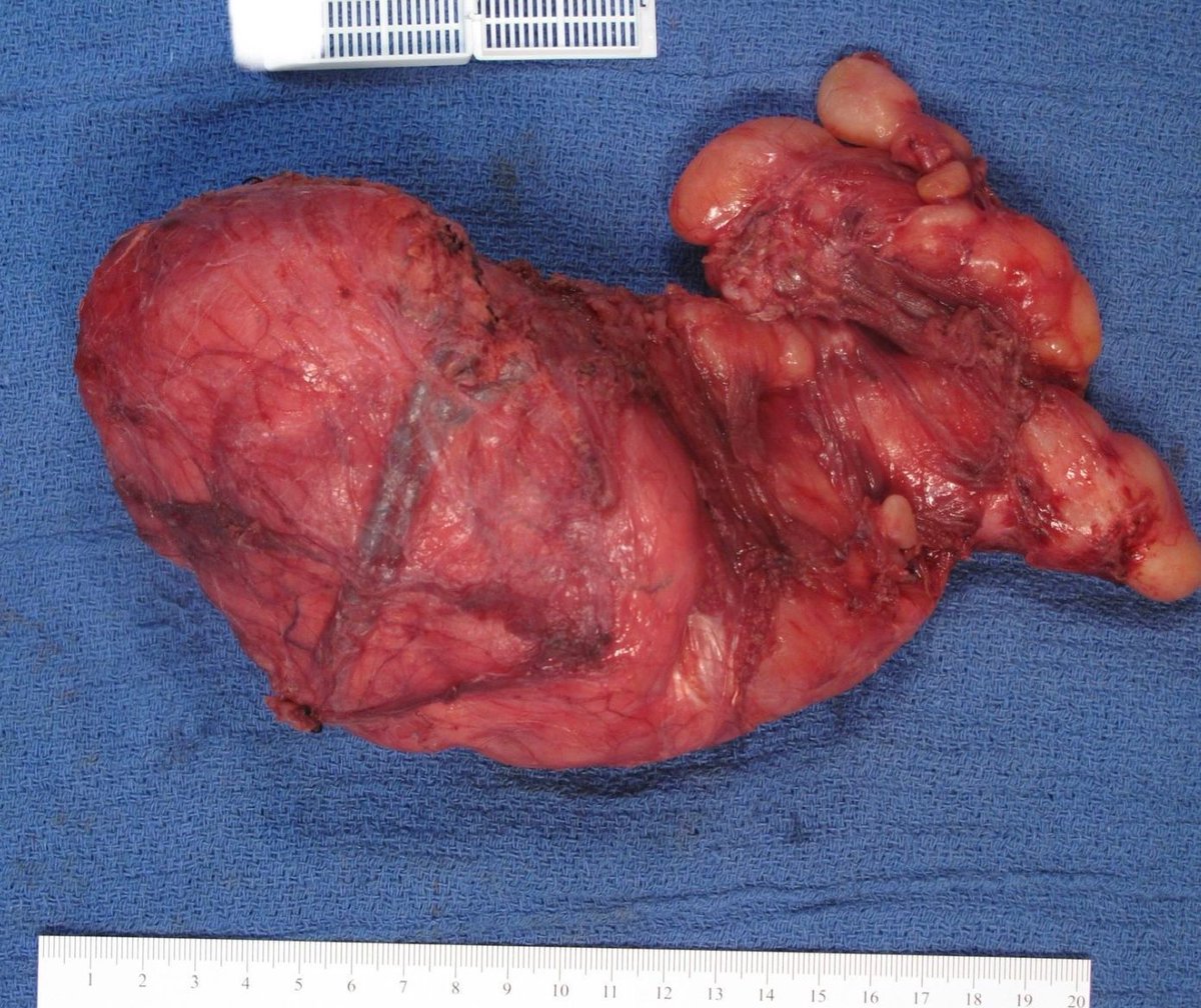 JMGardnerMD's tweet image. Deep soft tissue mass. Can you diagnose it on #grosspath only?
Digital slide: kikoxp.com/posts/24672 
More gross pics: kikoxp.com/posts/24674
Answer ✅ youtu.be/MPQhKllL2vc 
#pathology #pathologists #pathTwitter #dermpath #dermatology #dermatologia #dermtwitter #BSTpath