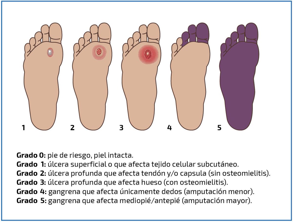 dgsverts's tweet photo. El pie diabético puede prevenirse si actúas a tiempo. Úlceras, dolor, cambios de color o falta de sensibilidad son señales de alerta. Cuida tus pies, cuida tu vida.

#Vertientes #CubaPorLaSalud #CubaPorLaVida https://t.co/KVNgGjQTLf