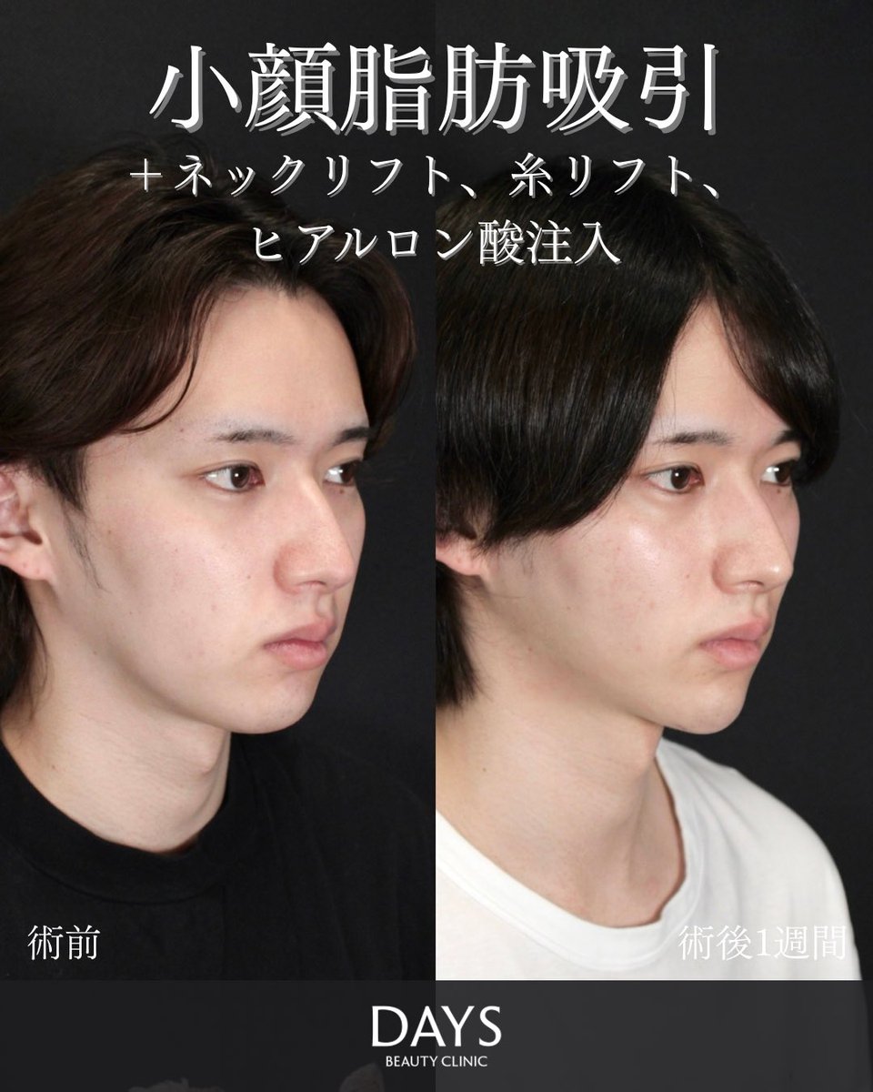 小顔整形 山野祐 tweet media