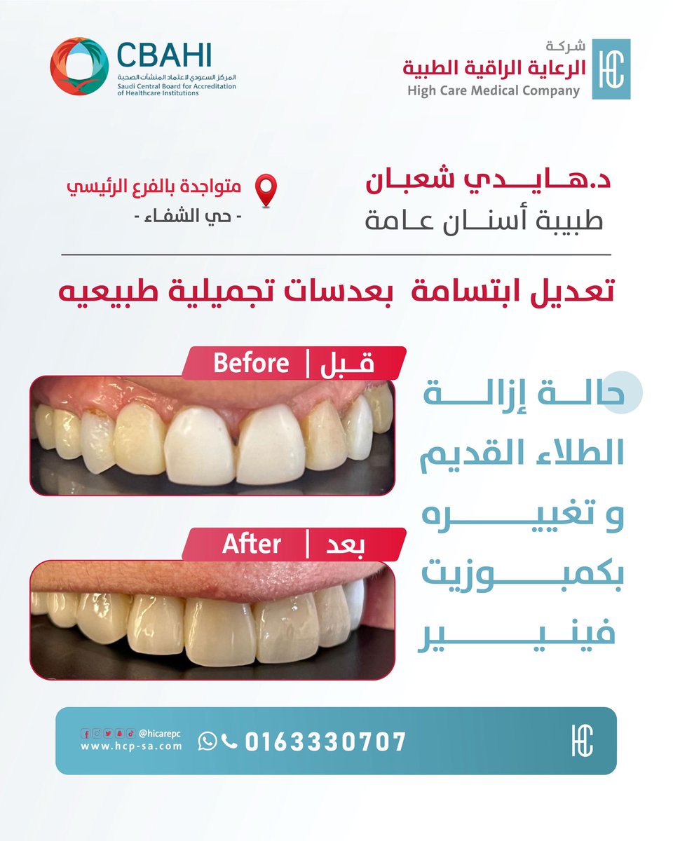 hicarepc's tweet photo. ابتسامة أجمل… بثقة أكبر ✨
كمبوزيت فينيير ابتسامة طبيعية

من حالات د.هايدي شعبان 🤍
طبيبة أسنان عامة 🦷

📍متواجدة بالفرع الرئيسي - حي الشفاء

🕰️ | لحجز موعدك او الاجابة على استفساراتك
الاتصال أو الارسال على الرقم الموحد
المخصص لخدمة العملاء 
0163330707 🤍

#اسنان #تجميل #ابتسامة #طبيعية