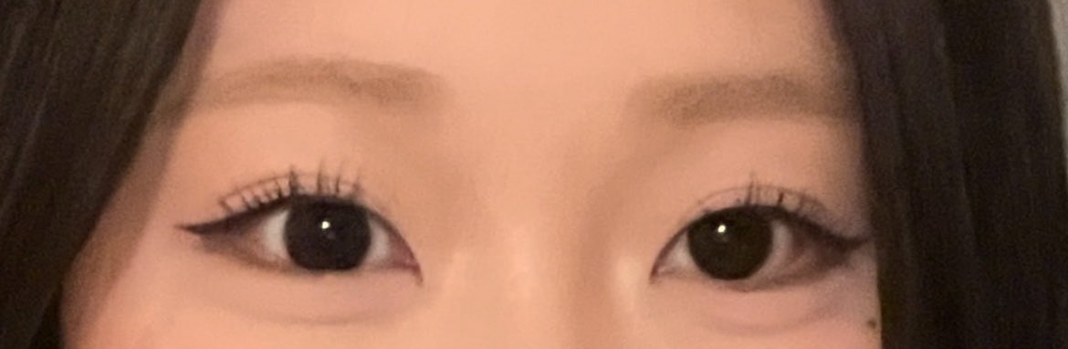 nini_______00's tweet photo. この片目出目で片目奥目って整形じゃ治せない？頬骨セットバックすると奥目解消したっていう人見かけるけど、奥目の左側は頬骨あんまり出てなくて右側が頬骨出てる😔😔トリックアートすぎる奇形😔💧 https://t.co/70tcipxIu6