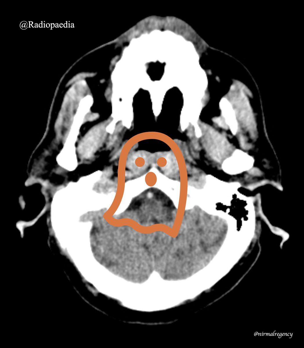 The Dense Vertebral Sign is perhaps a 👻Ghost. Has anyone seen them ...