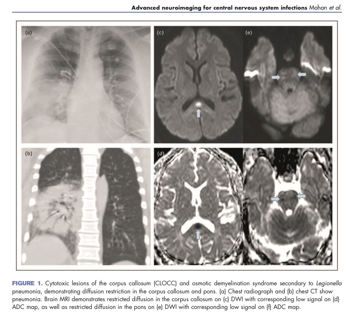 AliSMV7's tweet photo. Advanced neuroimaging for central nervous system infections: when, where, how, and why?

https://t.co/Wf94zNLmtJ https://t.co/8L0pkKu91N